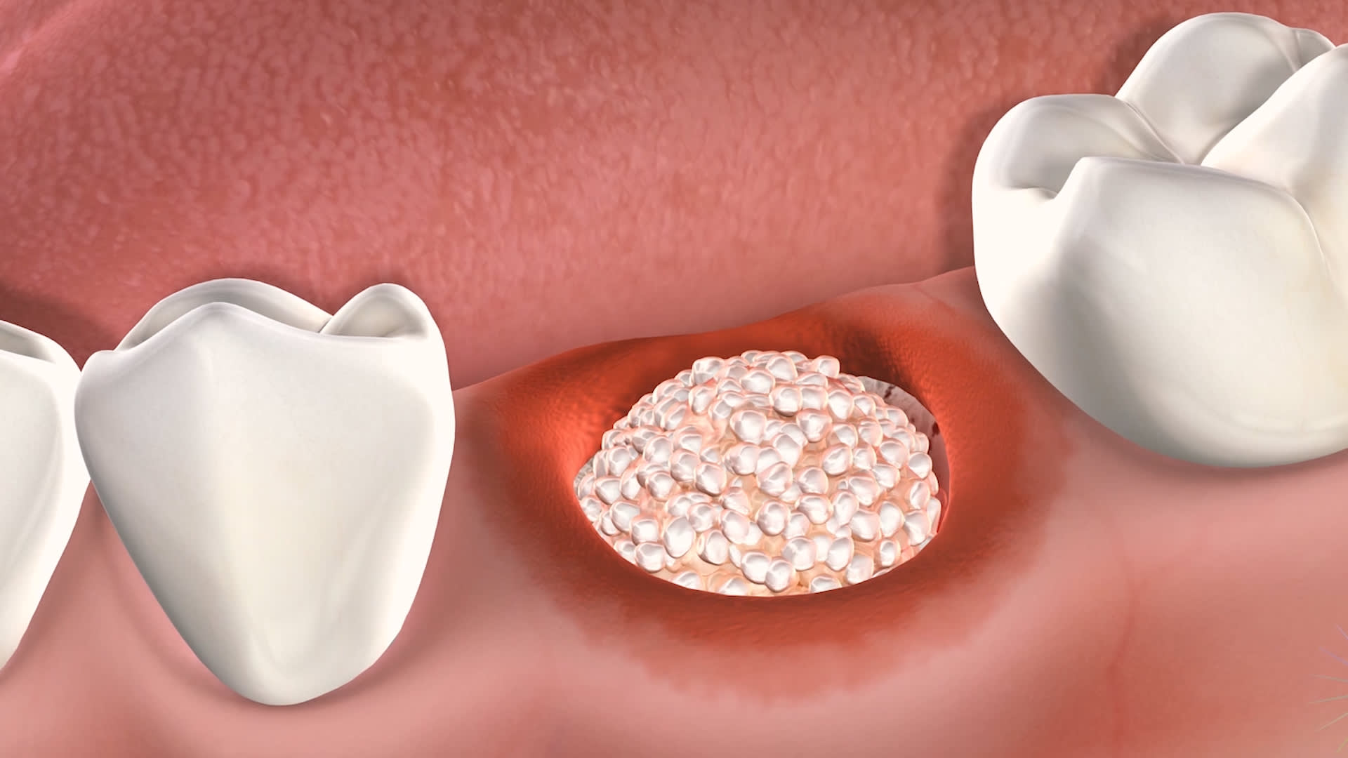 Bone grafting is a great option for patients with insufficient bone for a dental implant