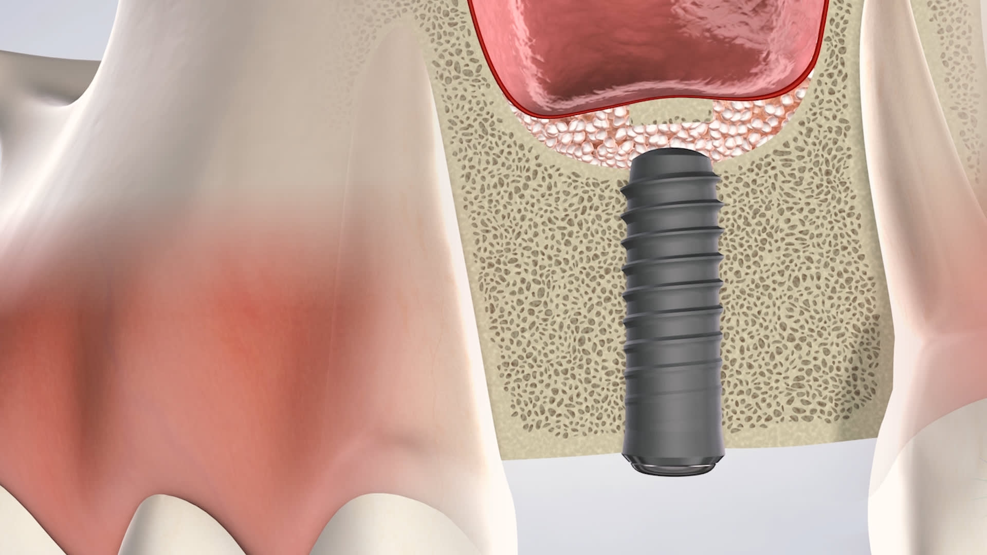 Dental implant post and sinus lift illustration