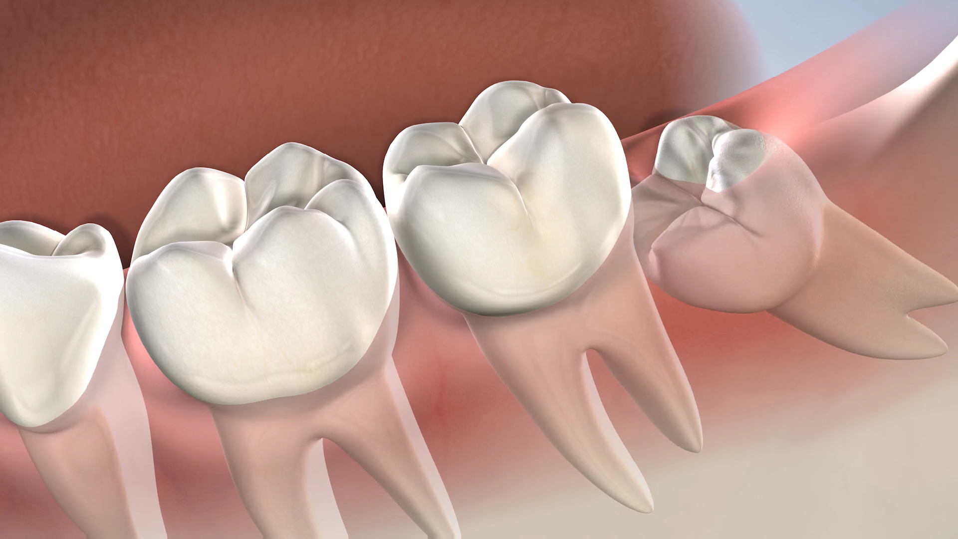 Illustration of an impacted wisdom tooth