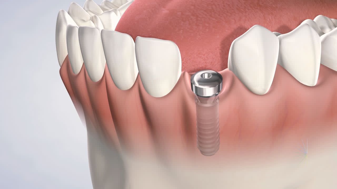 Dental Implants in Oklahoma City, OK
