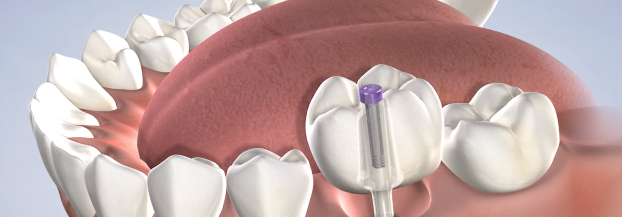 Dental implant procedure candidacy