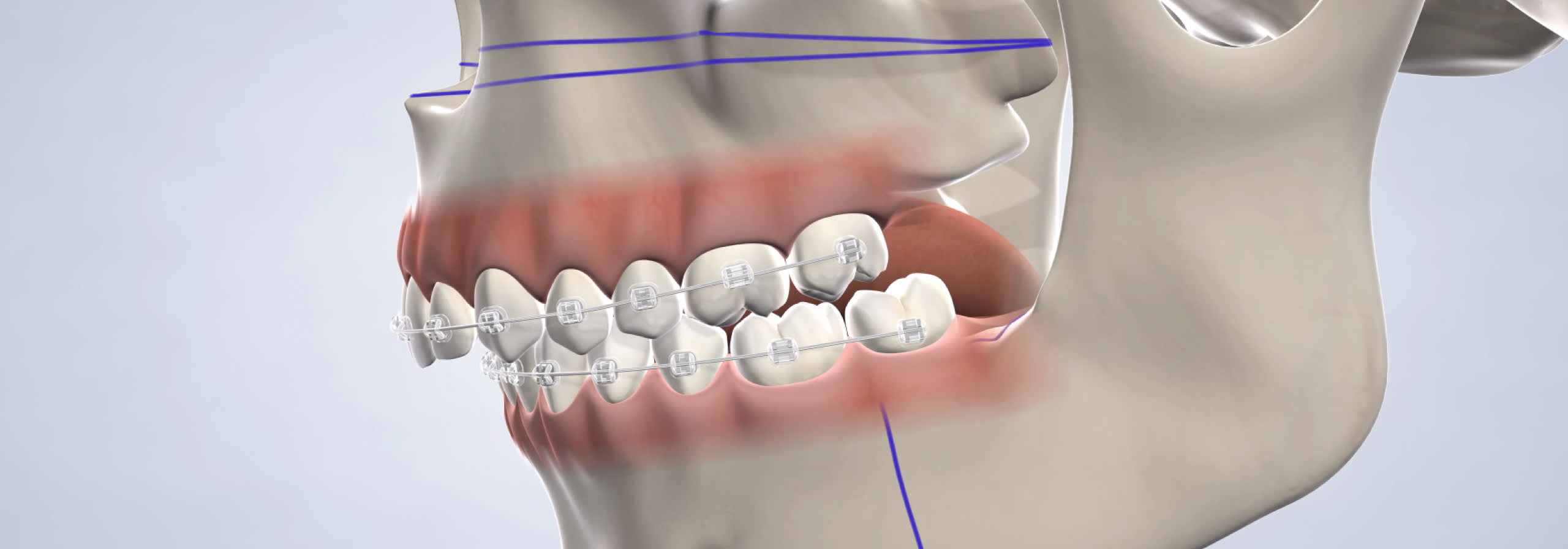 Home  orthognathic jaw surgery