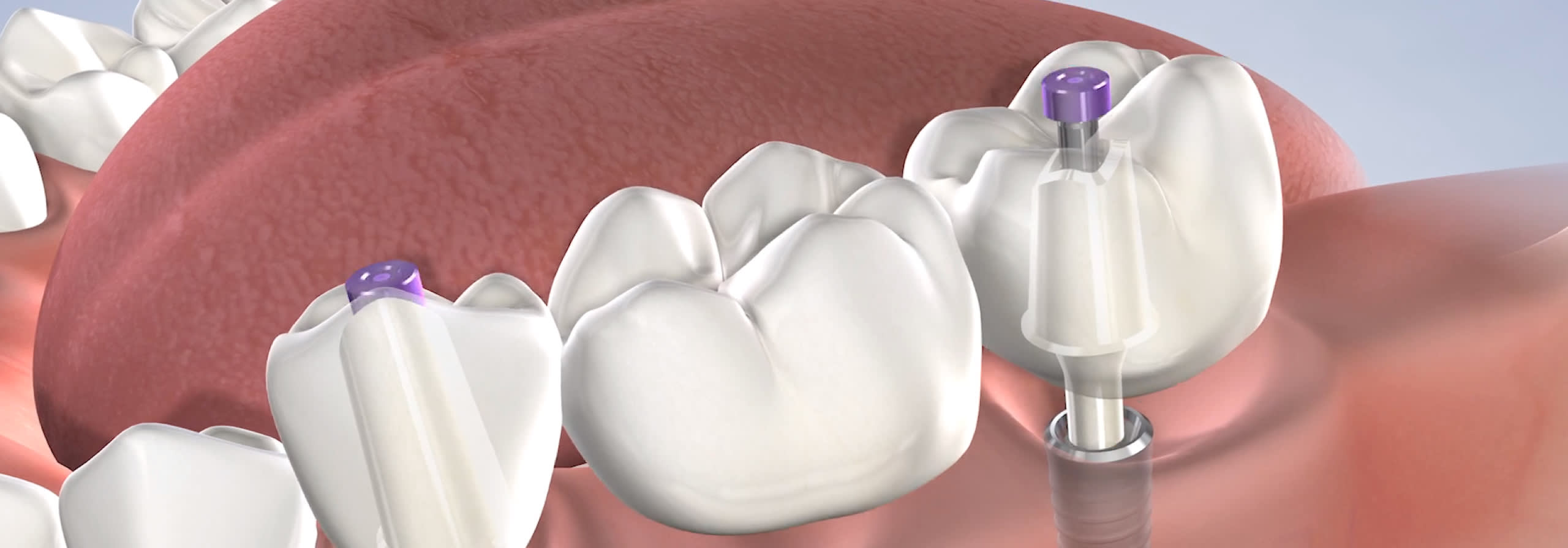 Benefits of Dental Implants in Oklahoma City, OK