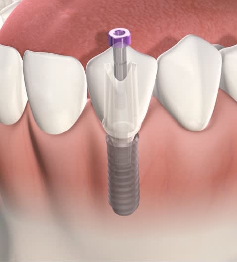 dental implant abutment in Oklahoma City, OK