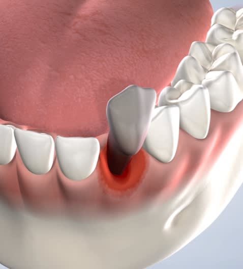 Illustration of a tooth extraction