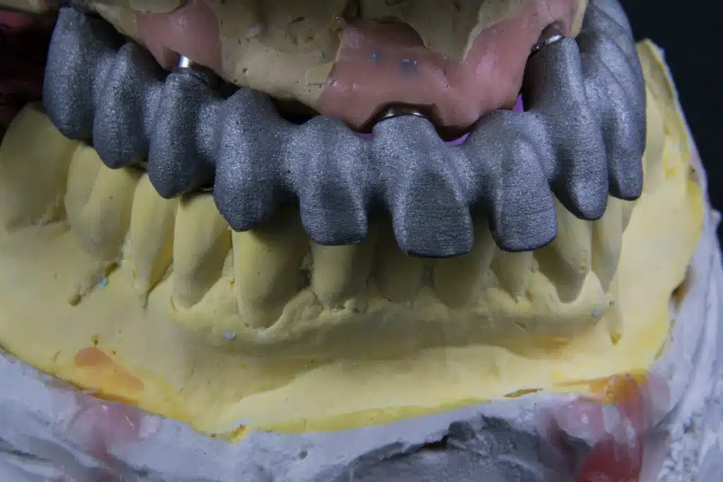 How Long Does It Take to Heal After a Dental Bone Graft?