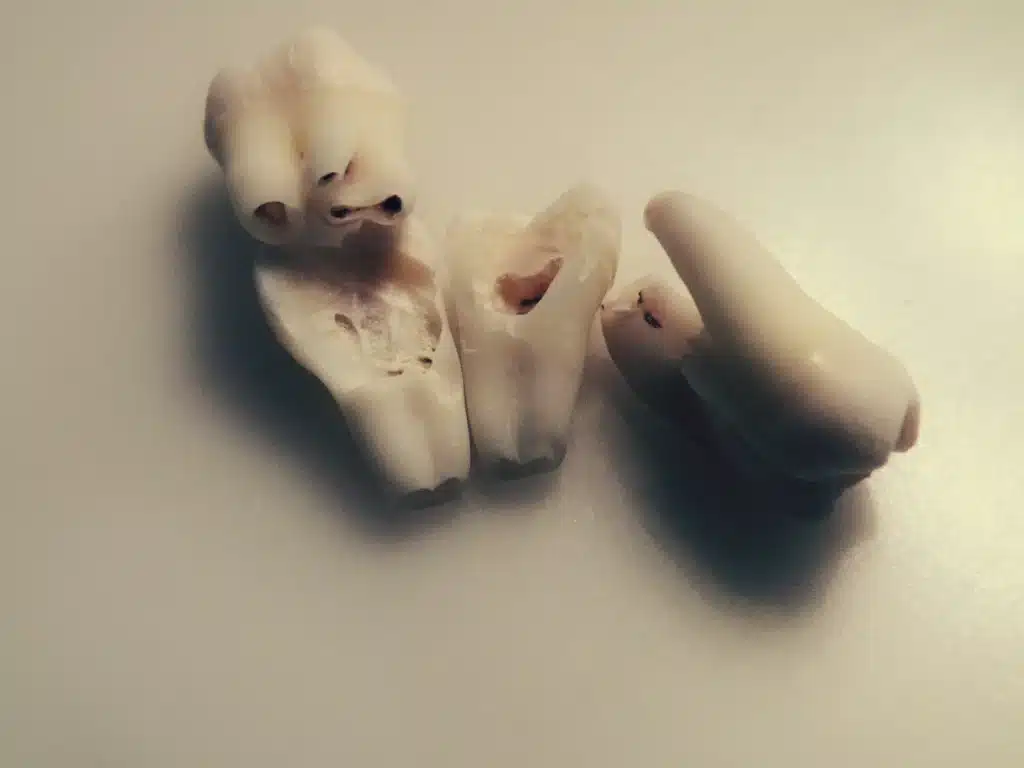 An extracted molar tooth that has been sectioned into several pieces during a surgical extraction procedure