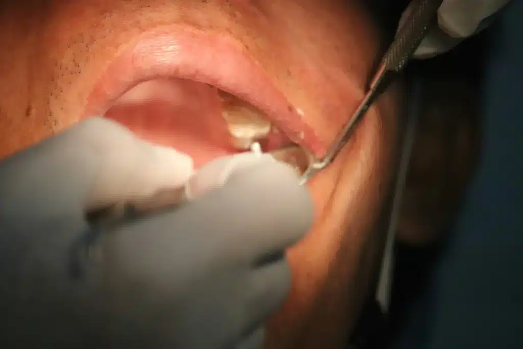 A close-up view of an intraoral dental procedure showing a practitioner using handheld instruments and a dental mirror to examine or treat a patient's upper teeth.