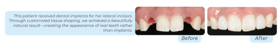 A before-and-after clinical comparison showing the restoration of a patient's lateral incisors using dental implants and customized soft tissue shaping: