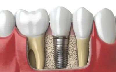 anatomy-of-healthy-teeth-and-tooth-dental-implant