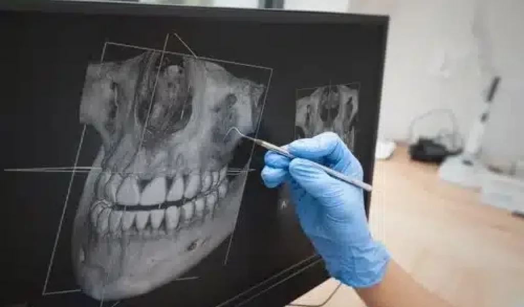 A gloved practitioner using a dental instrument to point at a 3D Cone Beam Computed Tomography (CBCT) scan on a computer monitor