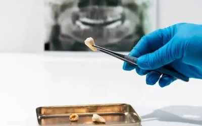 tooth extraction