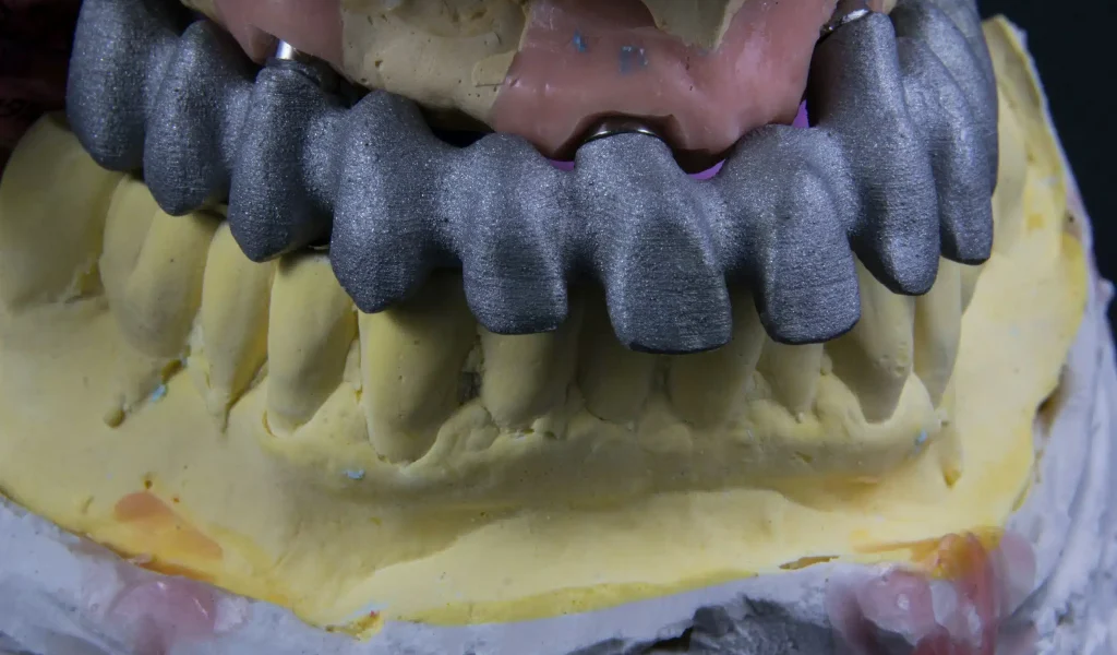 A custom metal framework for a full-arch implant-supported dental prosthesis mounted on a stone cast model