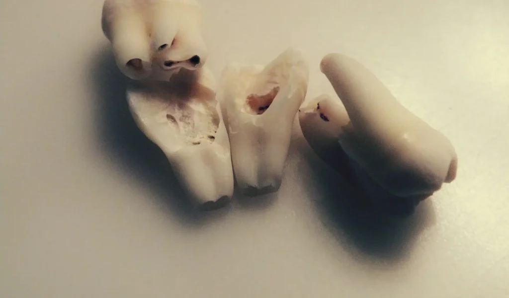 An extracted molar tooth that has been sectioned into several pieces during a surgical extraction procedure