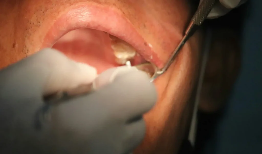 A close-up view of an intraoral dental procedure showing a practitioner using handheld instruments and a dental mirror to examine or treat a patient's upper teeth.